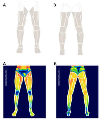 Figura 1. Termogramas dos membros inferiores, vista anterior (A) e posterior (B), destacando as RCI para avaliação da temperatura da pele.