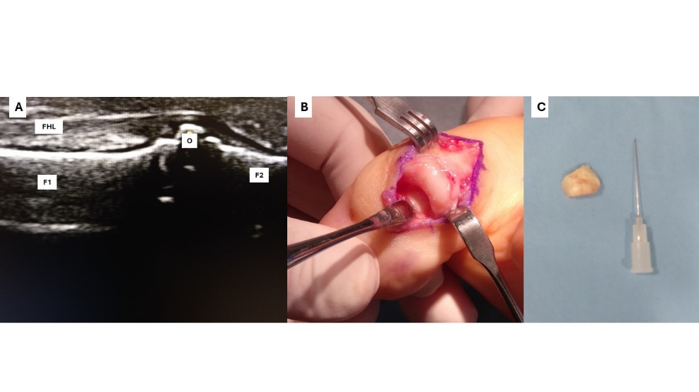 Figura 2. (A) Ecografía desde plantar de la articulación interfalángica donde podemos ver la falange proximal (F1) y la distal (F2), el osículo (O) y el flexor largo del hallux (FHL). (B) Osículo intraarticular tras disección de la articulación interfalángica desde dorsal. (C) osículo extraído quirúrgicamente de la articulación interfalángica comparado con una aguja 27G 0.4*0.25.