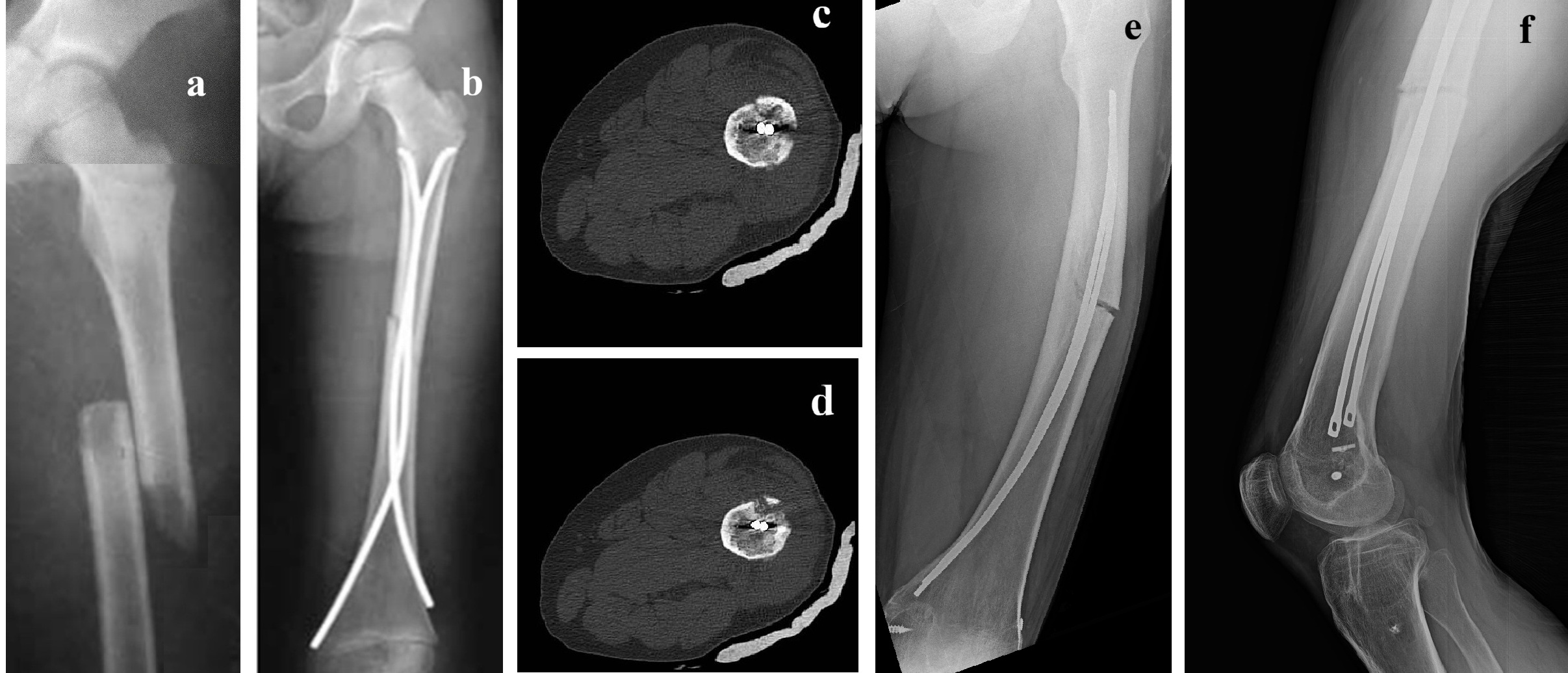 Figura 2. Radiografías de fémur izquierdo, en proyecciones anteroposterior y lateral, tras intervención de reducción abierta y fijación interna con placa atornillada.